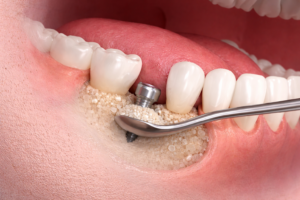 אוגמנטציה בלסת – ד"ר לדרמן מדגים השתלת עצם סביב שתל דנטלי כחלק מהכנת הלסת לשיקום קבוע