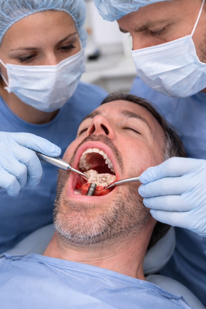 ד"ר לדרמן מבצע השתלת עצם בלסת במהלך טיפול כירורגי, בליווי צוות רפואי ובשימוש במכשור מתקדם להכנת הלסת לשתלים דנטליים