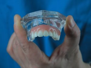 השתלת שיניים ביום אחד