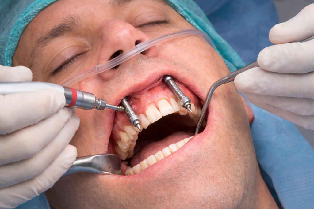 ד"ר לדרמן מבצע השתלת שתלים זיגומטיים בלסת העליונה באמצעות מכשור כירורגי מתקדם, תוך עבודה מדויקת ועדינה בסביבת הפה